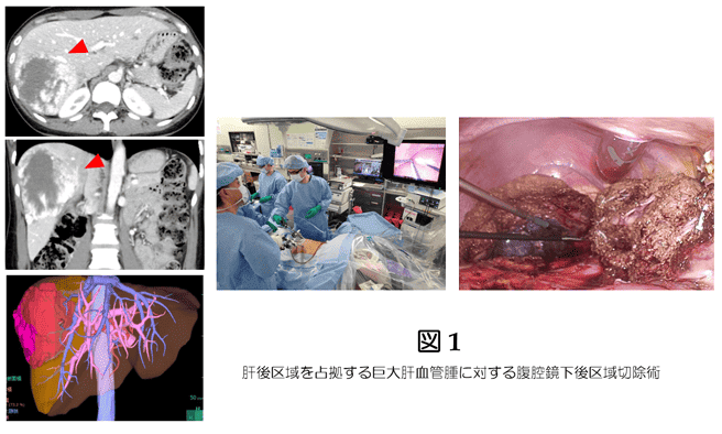 肝後区域を占拠する巨大肝血管腫に対する腹腔鏡下後区域切除術