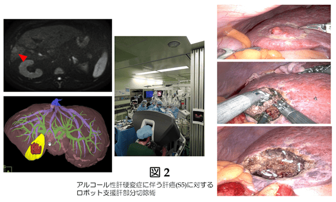 アルコール性肝硬変症に伴う肝癌(S5)に対するロボット支援肝部分切除術