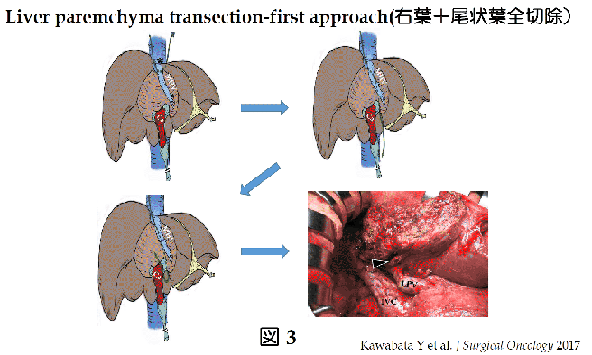 肝後区域を占拠する巨大肝血管腫に対する腹腔鏡下後区域切除術