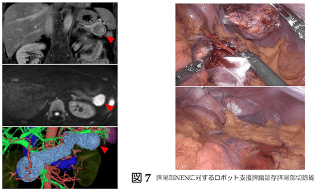 胆道癌に対する系統的腸間膜切除術